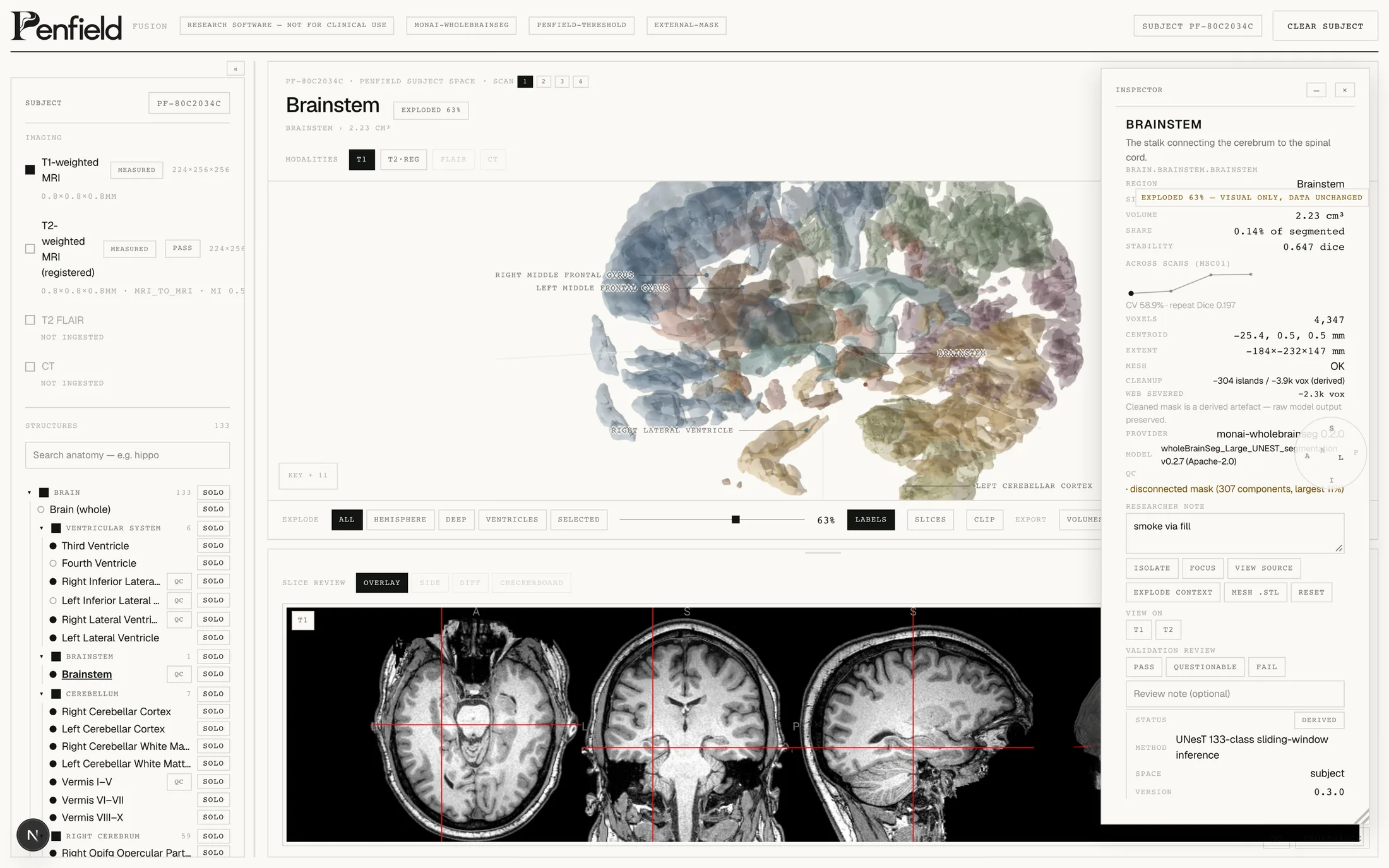 Penfield Fusion exploded anatomical view of brain structures