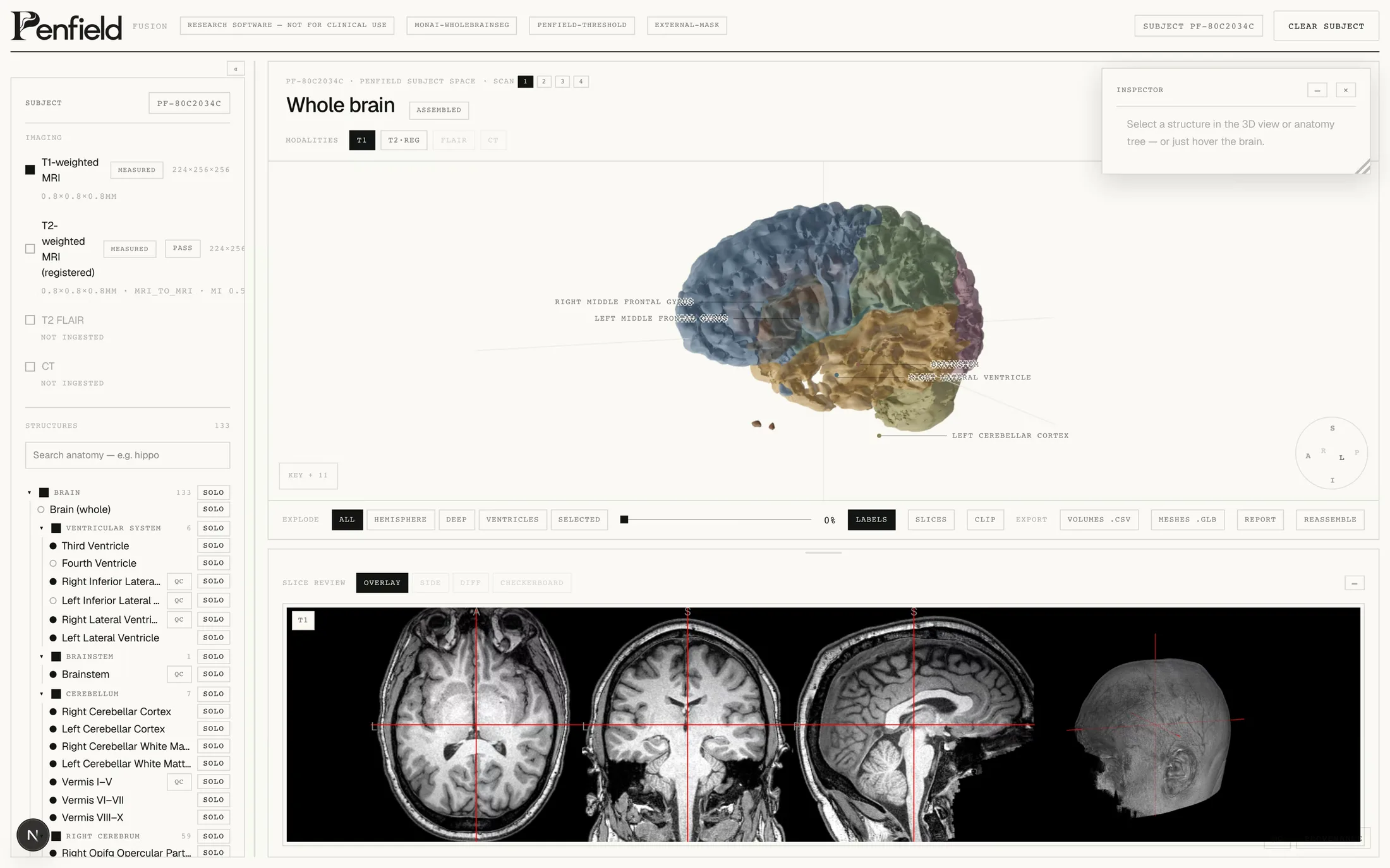 Penfield Fusion whole-brain imaging workspace with assembled 3D anatomy and slice review